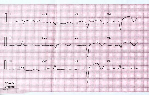 有醫生看一眼心電圖就說冠心病有醫生卻說心電圖沒用實情是