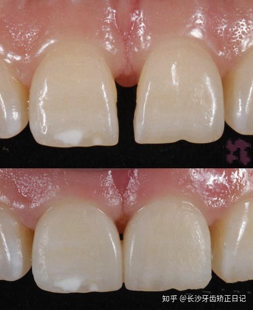 我的牙缝很大能补吗