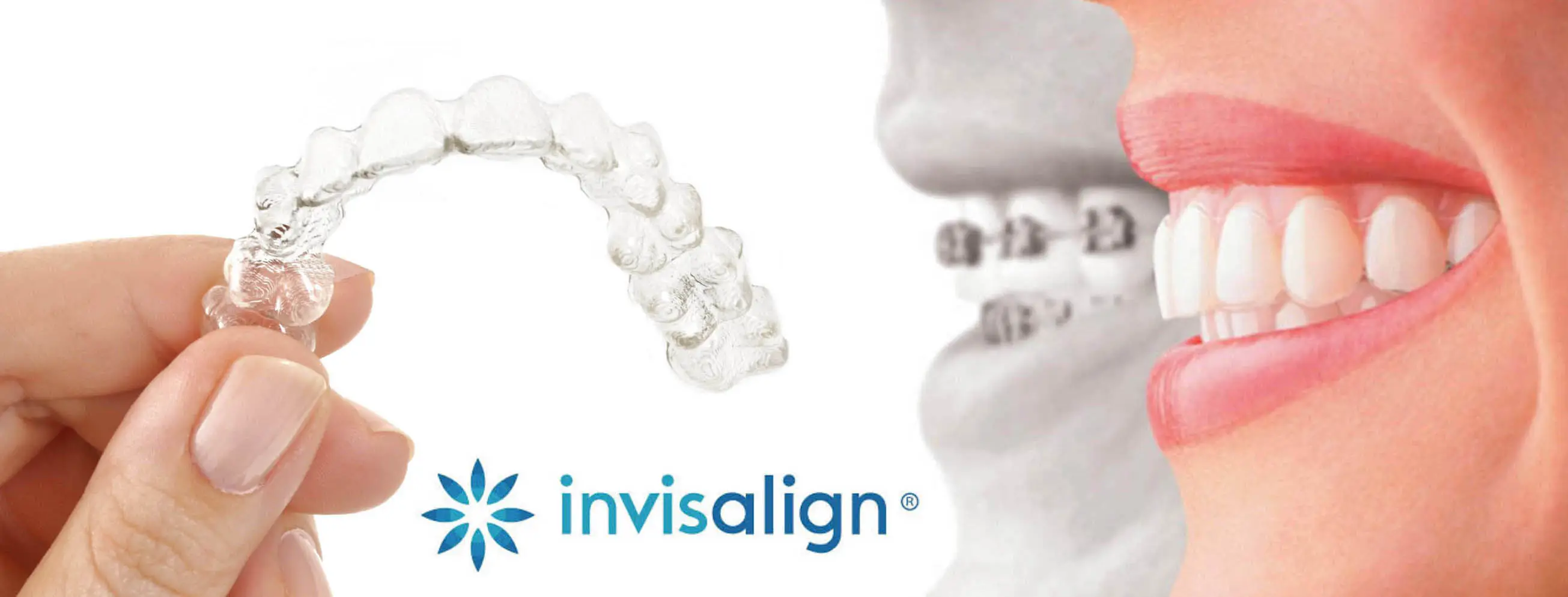 沈阳隐适美矫正哪些医院做的比较好为什么隐适美比传统时间长费用怎么