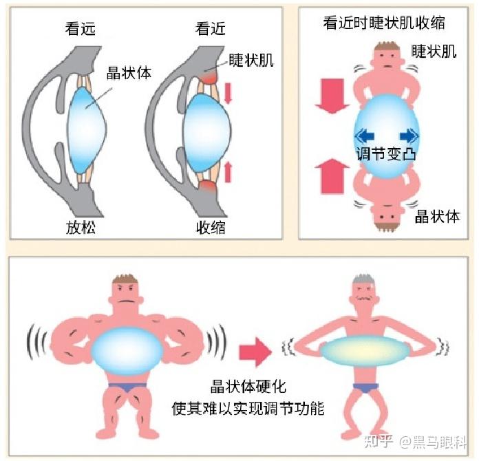 老花原来是眼睛“老化”？中年以后，这些征兆需重视 - …