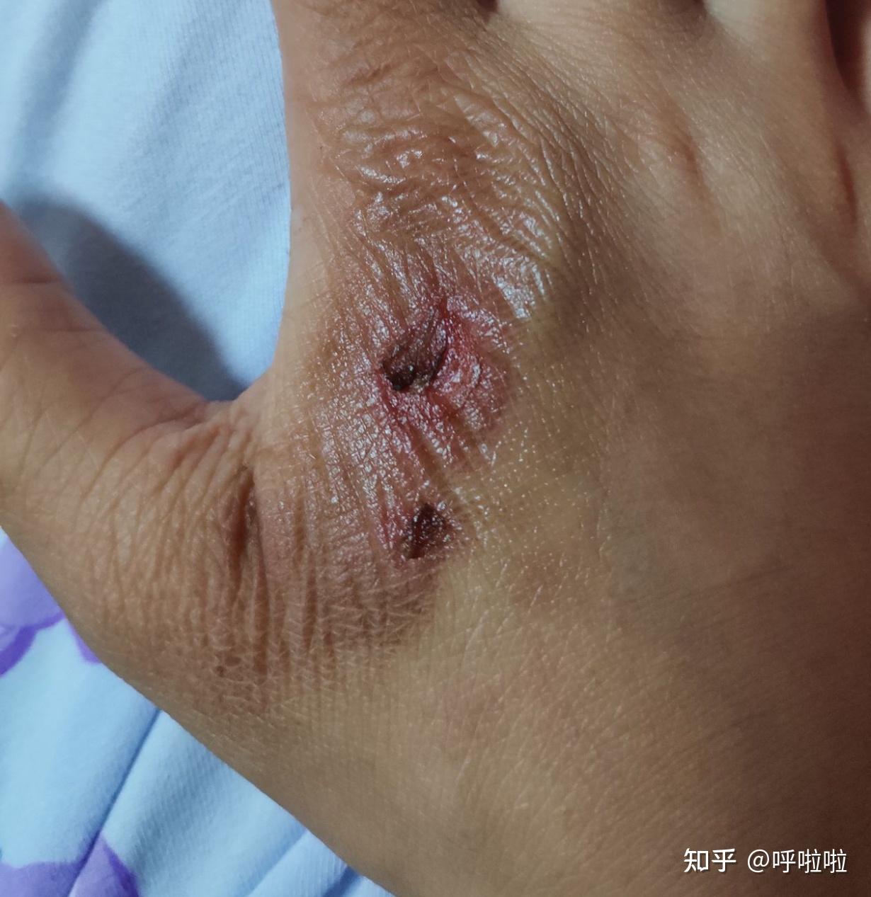 被开水烫伤手掌两个星期痊愈记录带痊愈图片