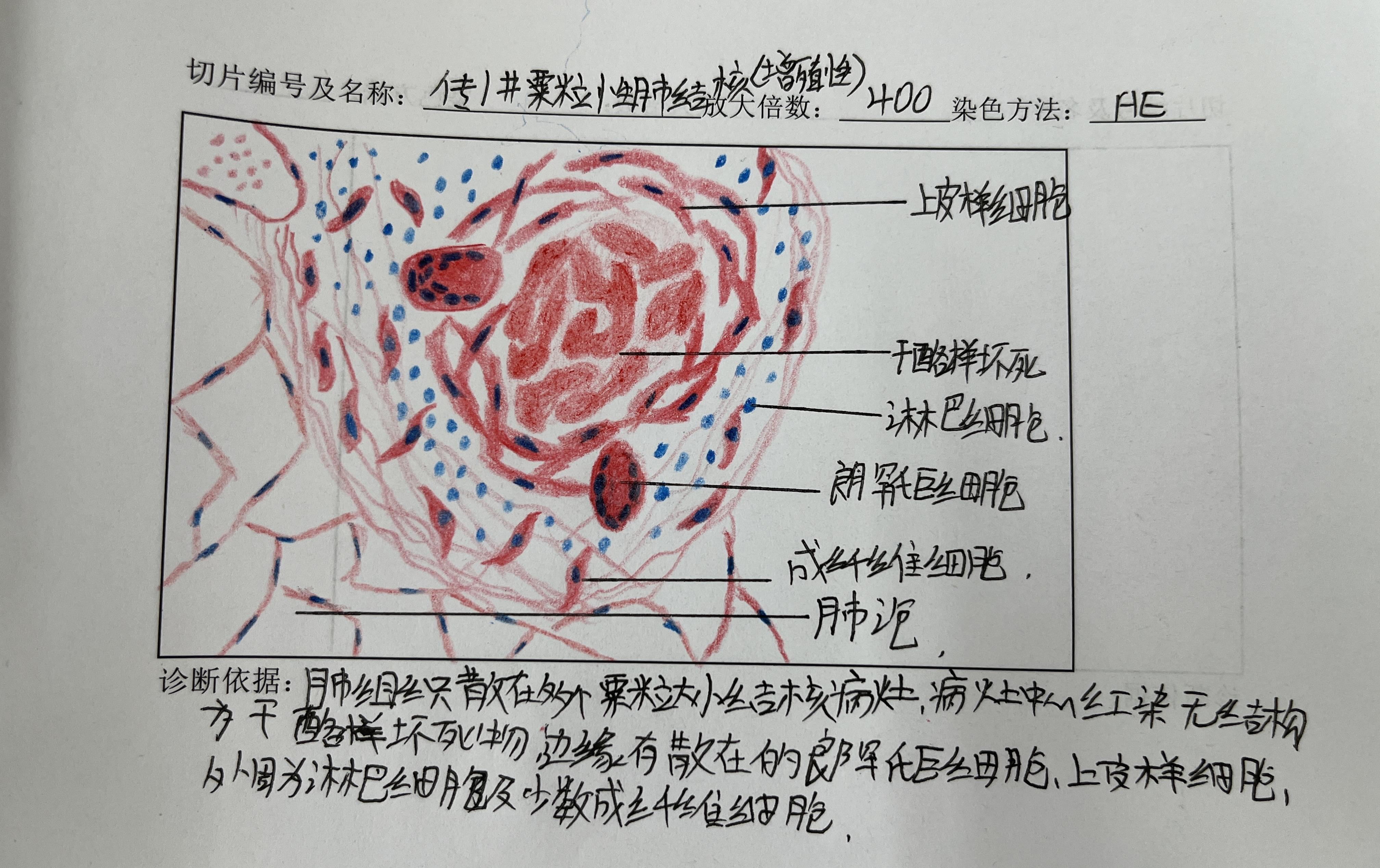 干酪样坏死镜下观图片图片