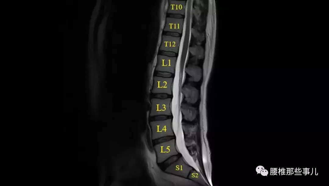 腰椎间盘突出压迫马尾神经怎么办