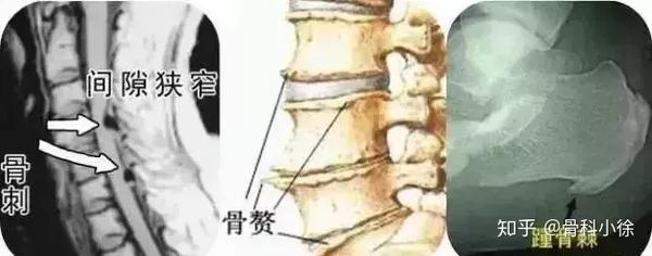 科普 | 长“骨刺”了怎么办? - 知乎