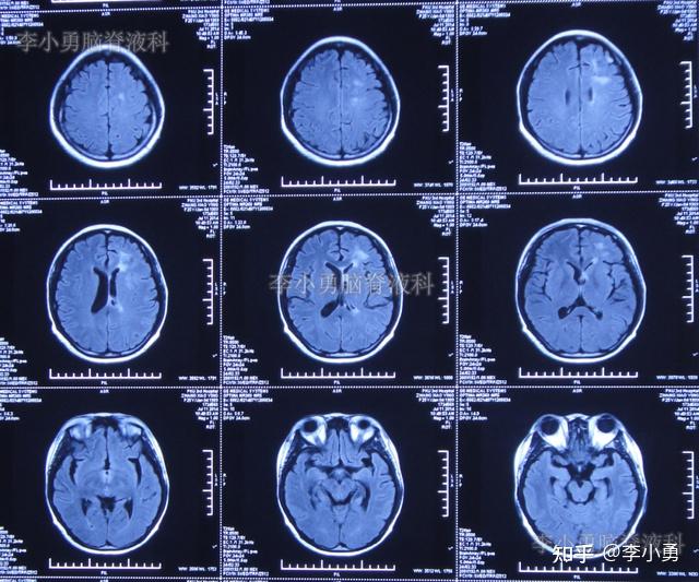 系統紅斑狼瘡繼發多重顱內感染致命腦積水李小勇腦脊液