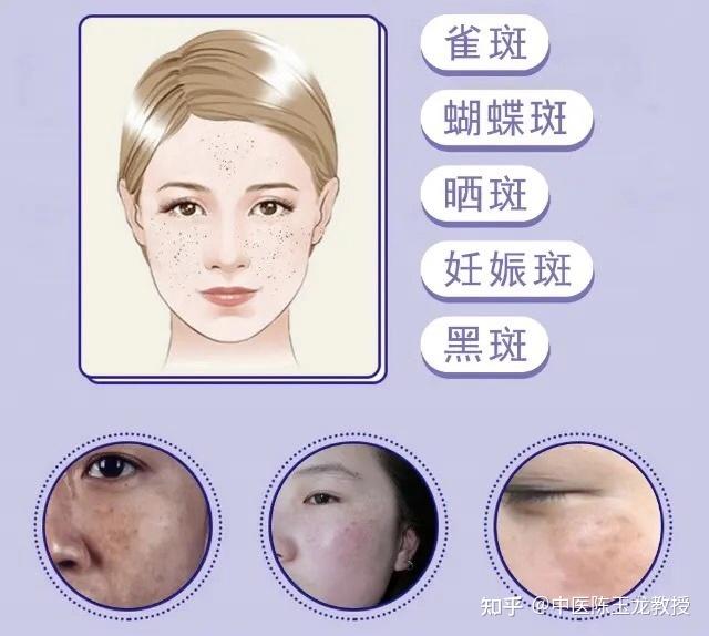 产后面色黄暗、黧黑、斑块多？可能是水斑，老中医教你解决办法 - 知乎