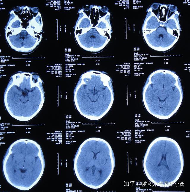 系统性红斑狼疮性脑膜脑室炎性双侧孤立颞角性脑积水经李小勇脑脊液科