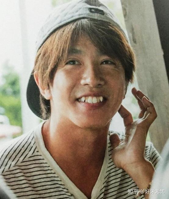 虎牙文化日本人牙齿畸形的原因