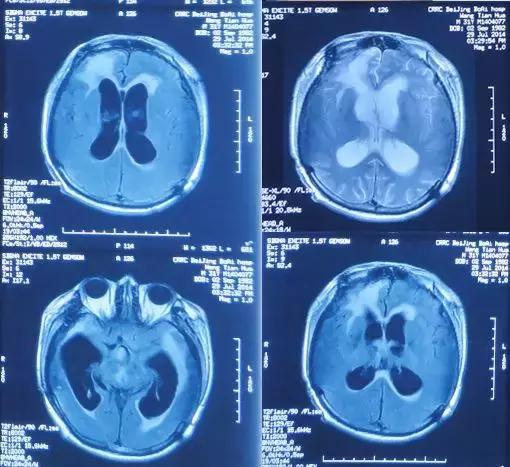 车祸脑重伤开颅术后留偏瘫 颅骨修补后再添脑积水和颅内感染 虽判为 死刑 却因脑脊液科奇迹完好生还