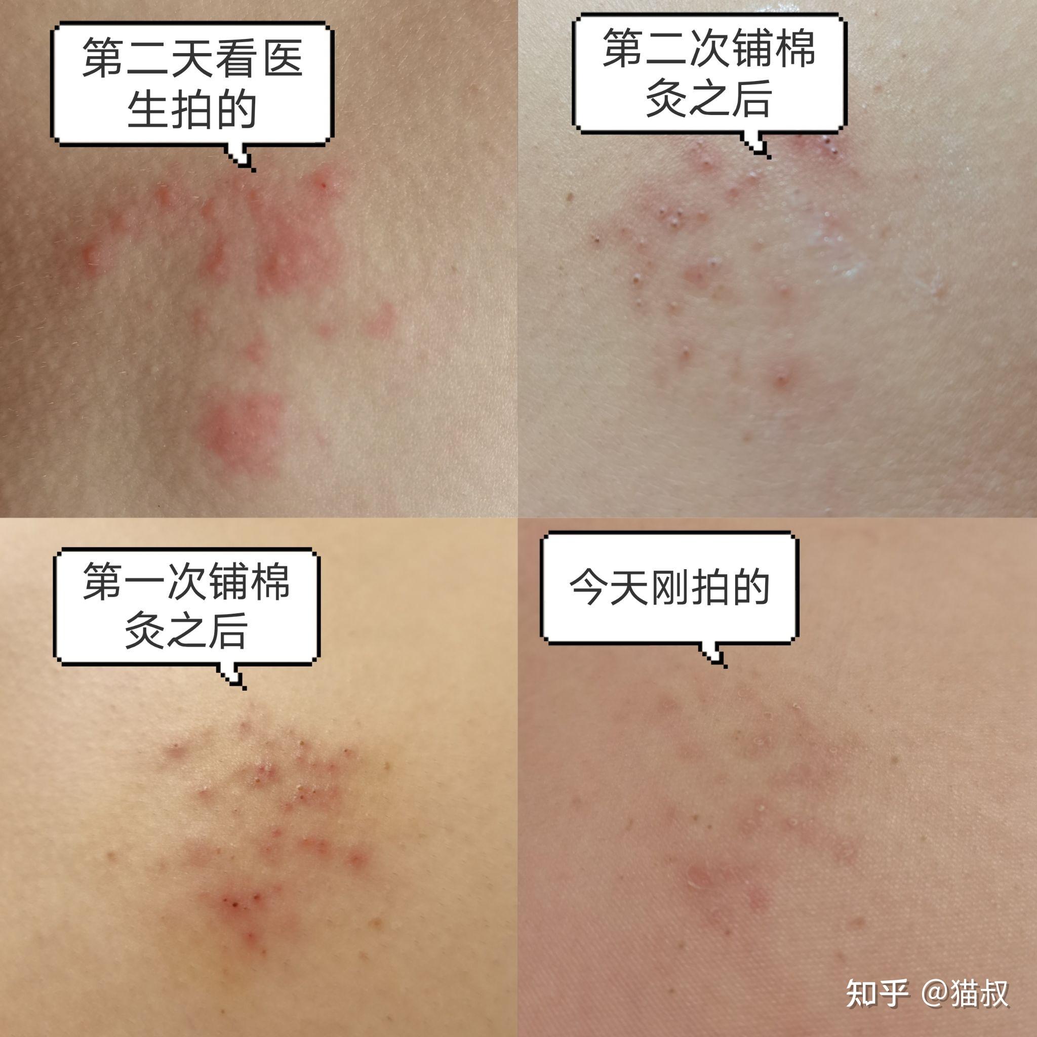 疱疹是怎么引起的可以 吗_疱疹_北京京城皮肤医院(北京医保定点机构)