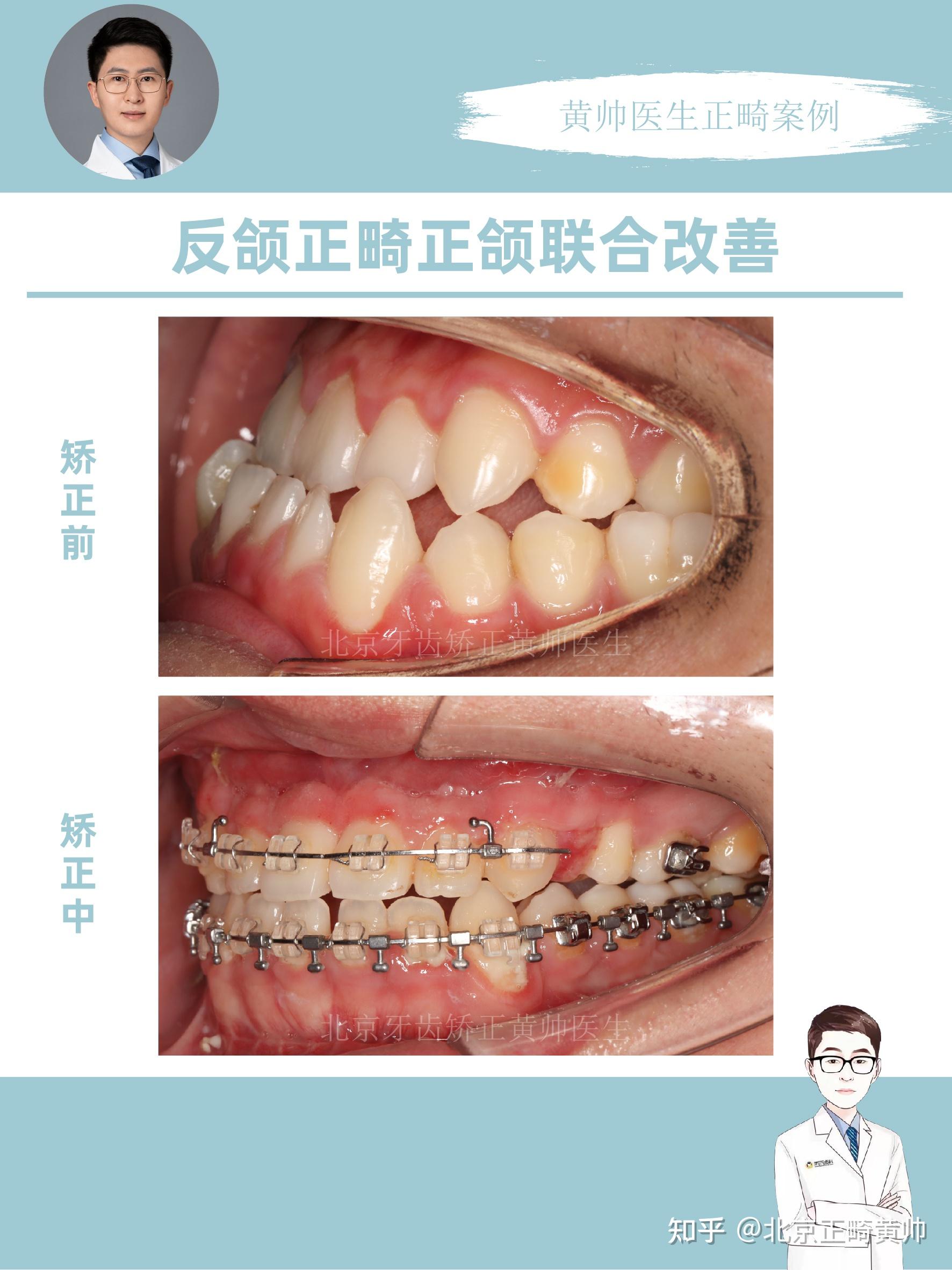 正畸正颌联合治疗案例分享,你更愿意正畸还是正颌呢? - 知乎