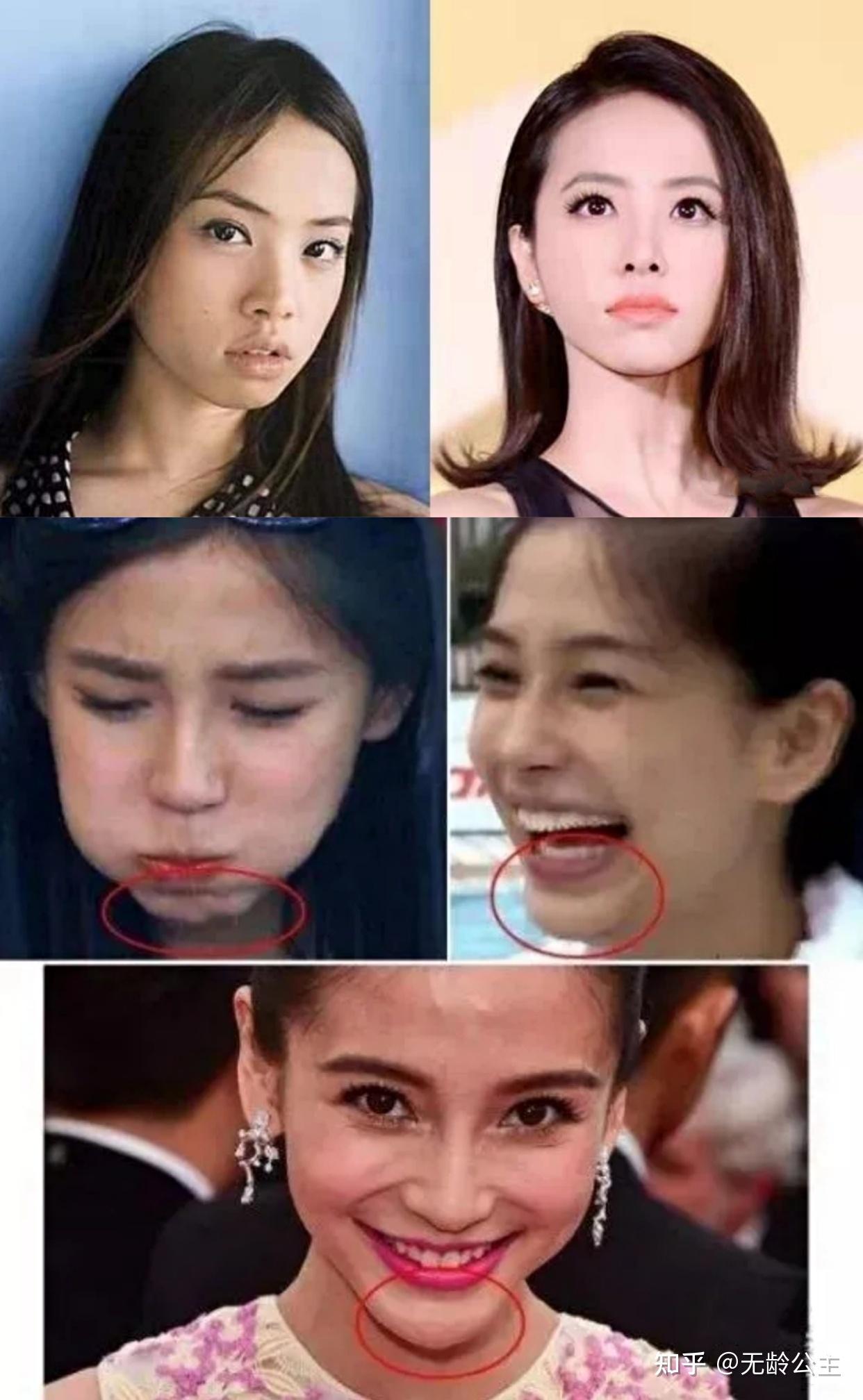 警惕「玻尿酸深层注射下巴」的后遗症