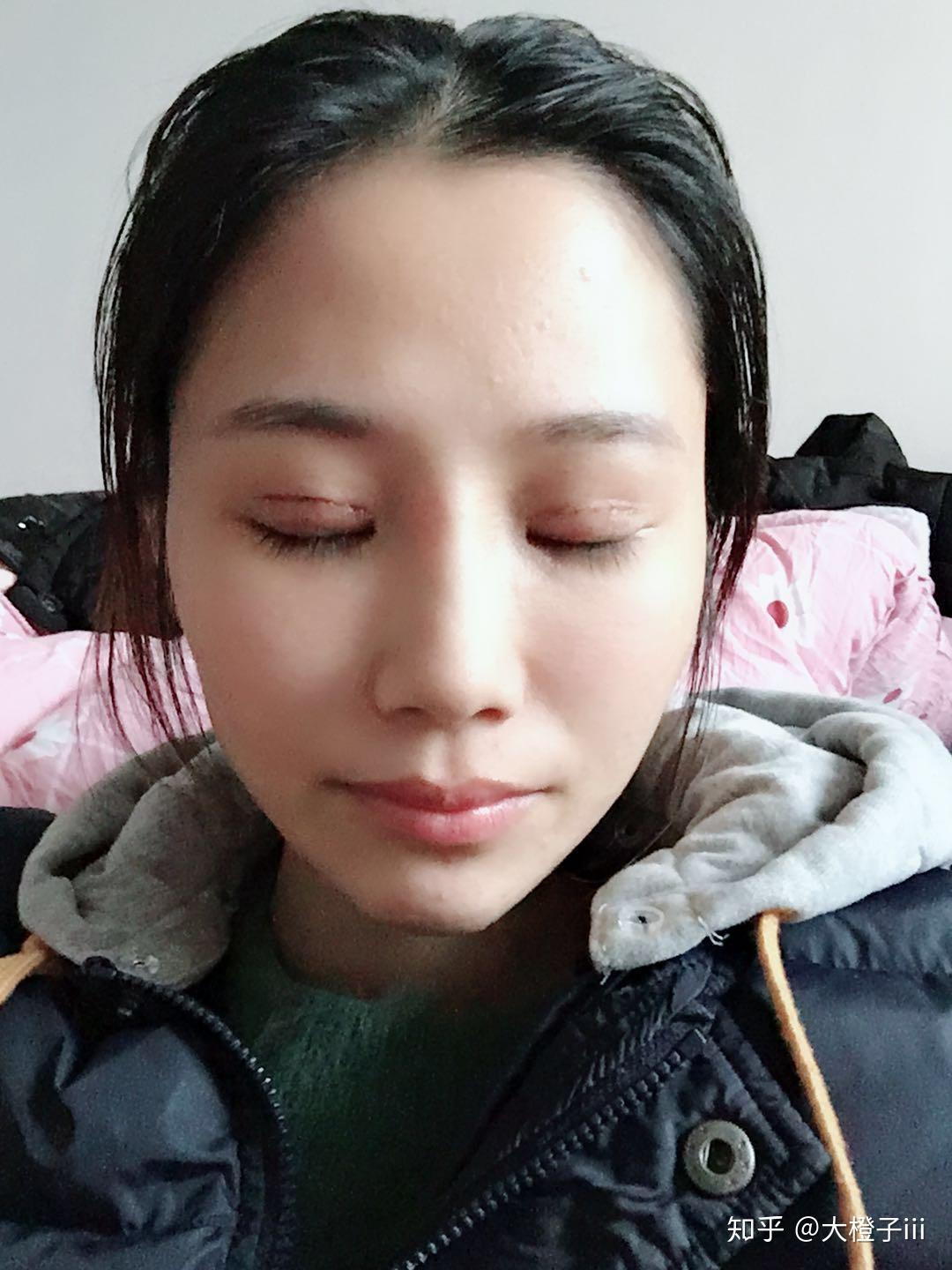 今天割双眼皮的第十天了