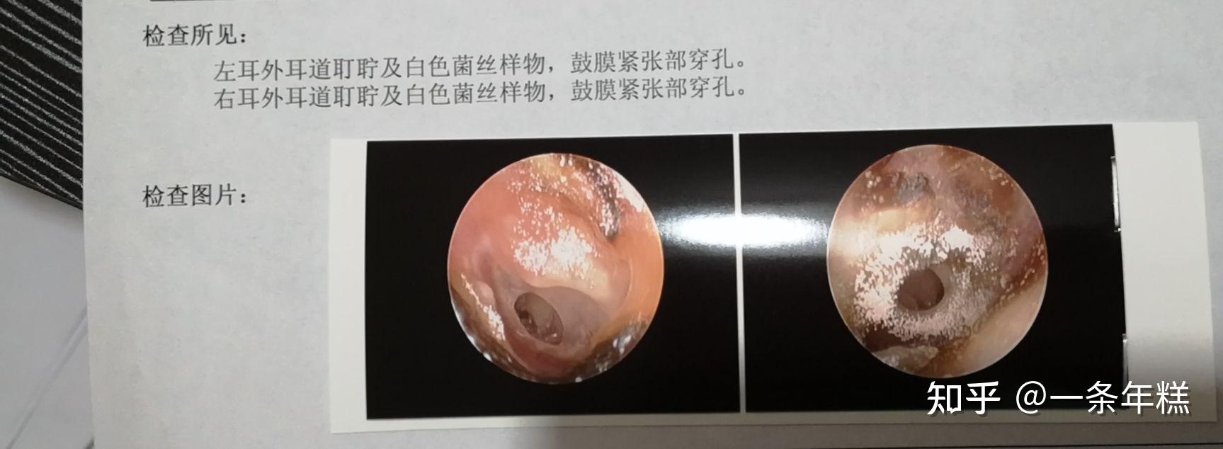 中耳炎耳镜图图片