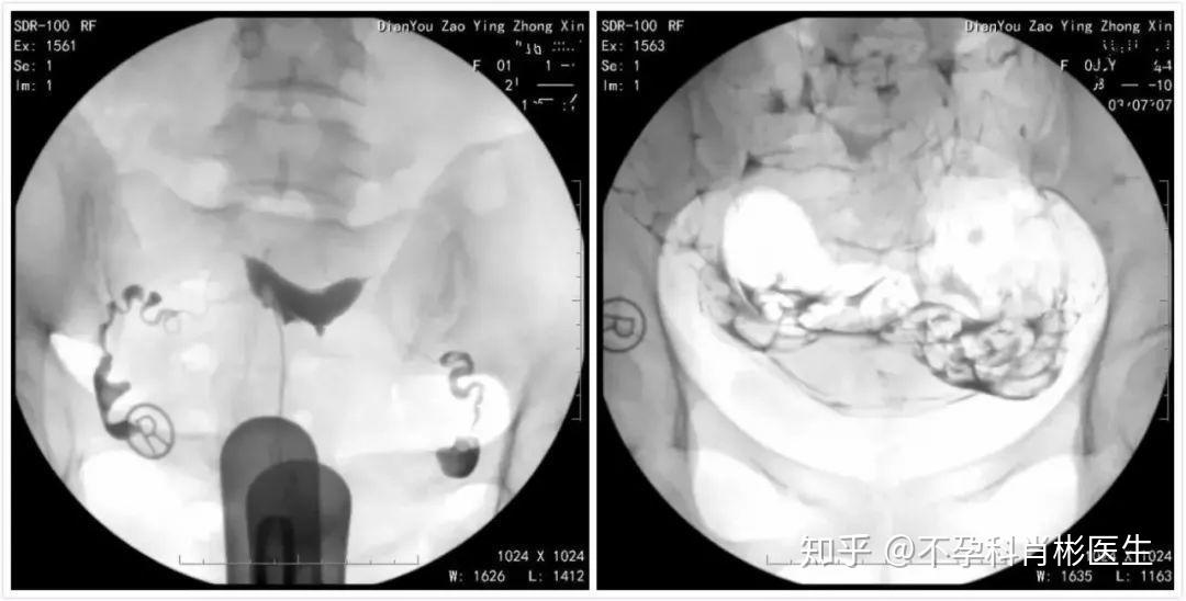 什么时候检查输卵管是否堵塞 v2-f3d09f6df50a7e0572b043d01e3ed37d_r.jpg