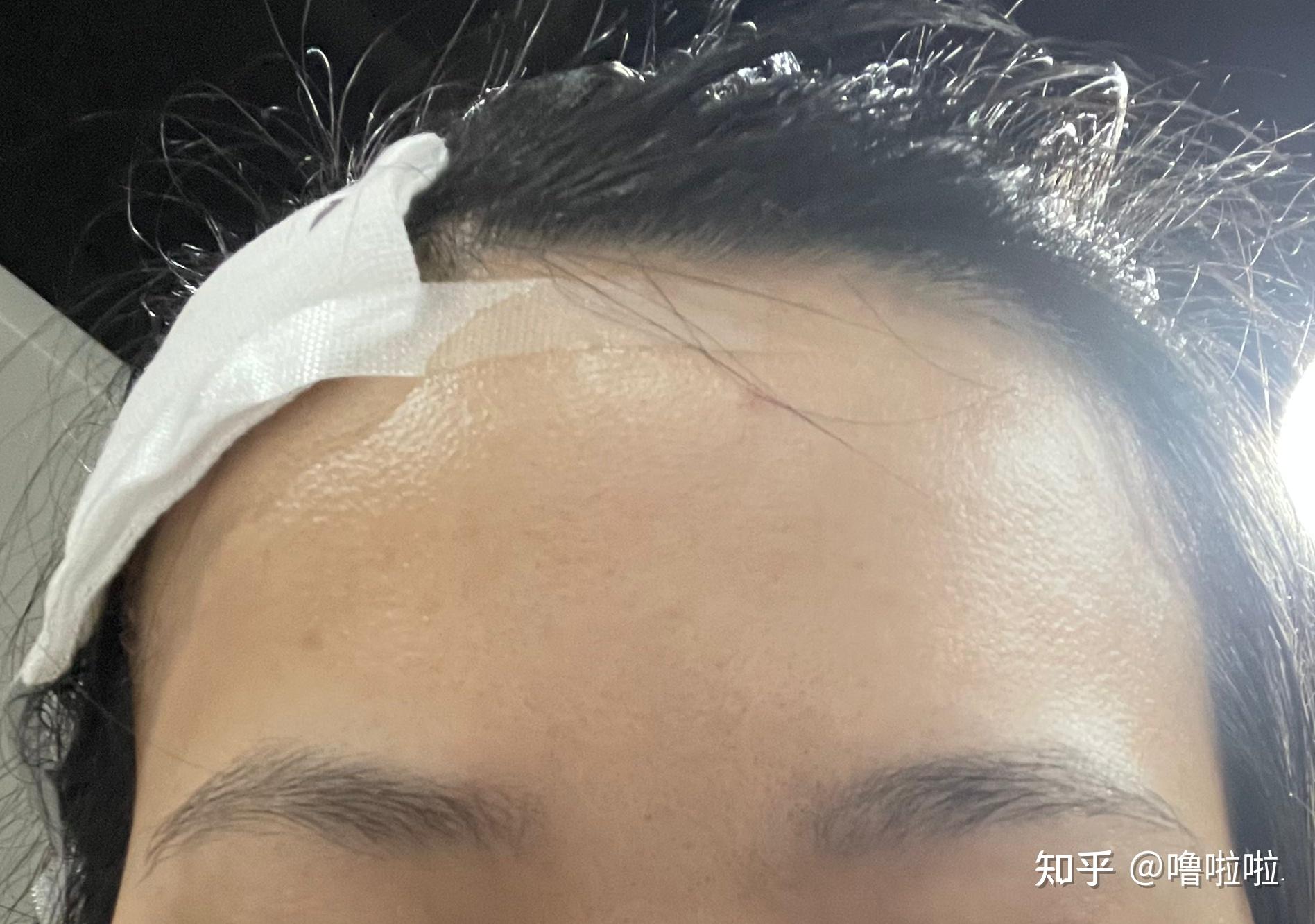 颅骨良性骨瘤日间手术记录