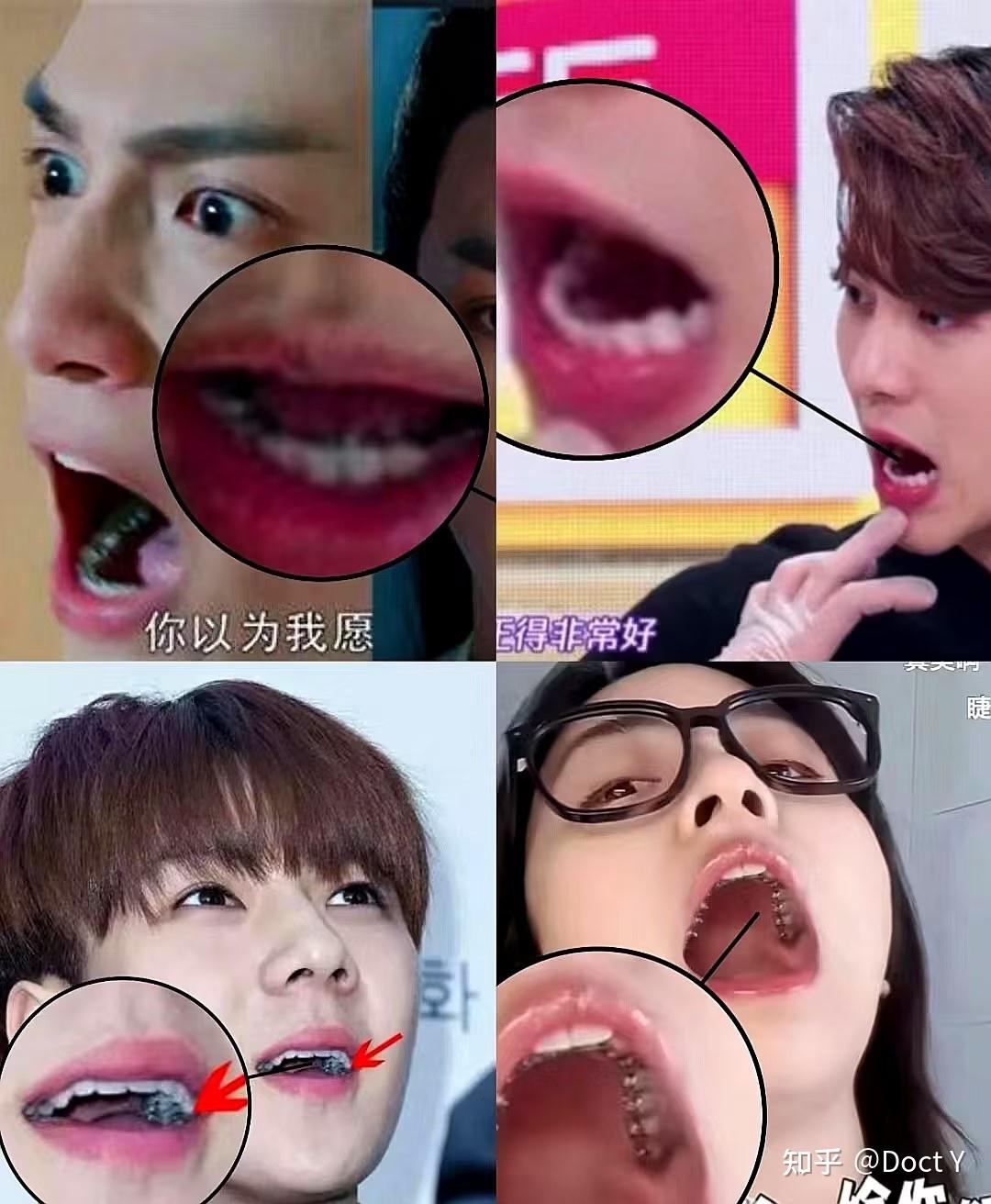 来揭秘:很多明星都在做的舌侧矫正怎么样?比普通矫正好在哪?4大亮点:美观、扩弓、咬合、周期,值得冲! - 知乎