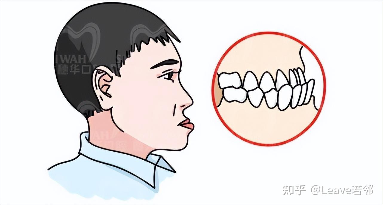 03,"地包天"对孩子有什么危害?