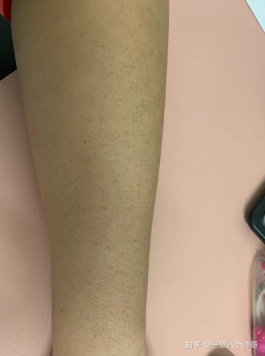 鸡皮肤洗完澡干燥瘙痒(鸡皮肤洗完澡干燥瘙痒用什么药) 鸡皮肤洗完澡干燥瘙痒(鸡皮肤洗完澡干燥瘙痒用什么药)