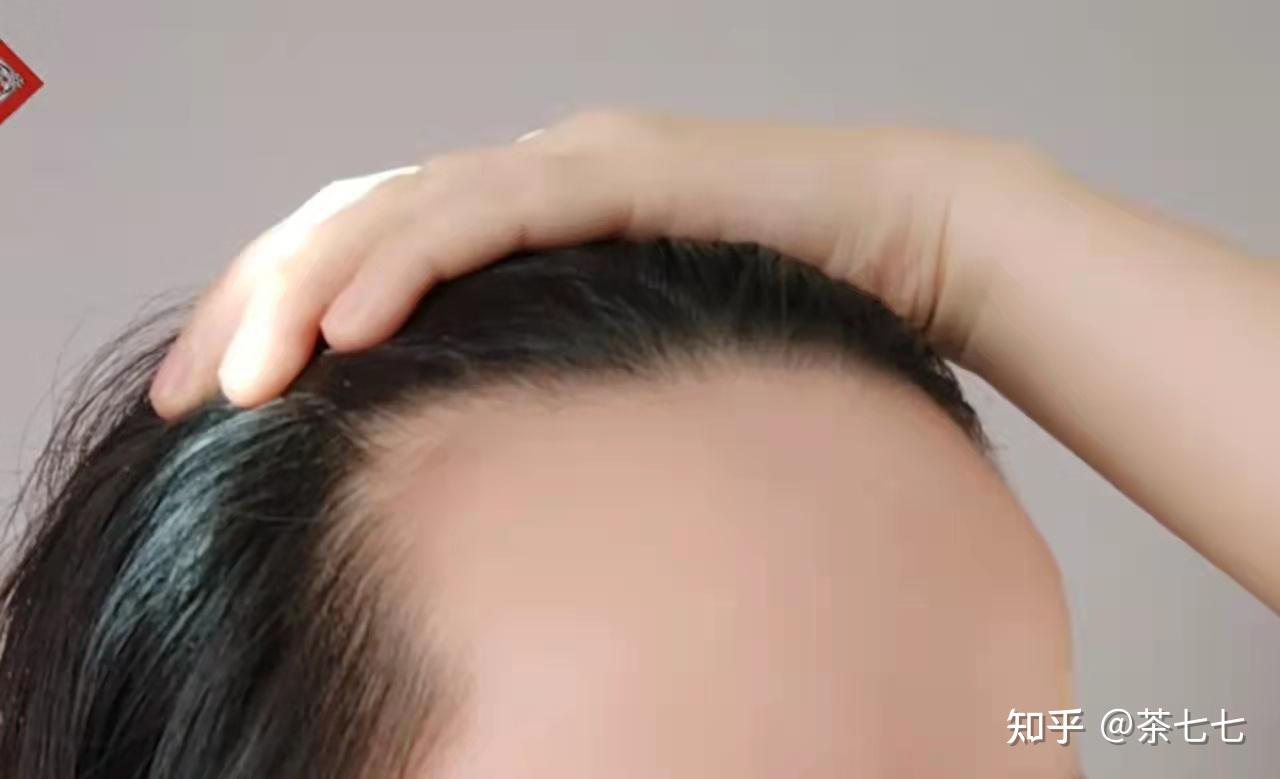 如何增加头发?怎样成为发量王者! - 知乎