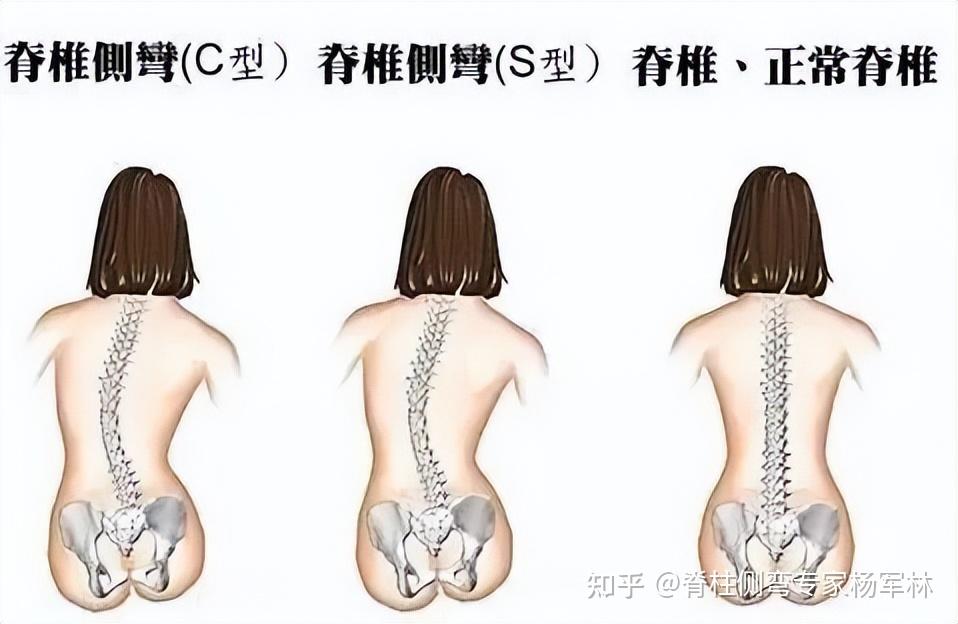破坏美感的"剃刀背" ,可能是脊柱侧弯引起的! - 知乎