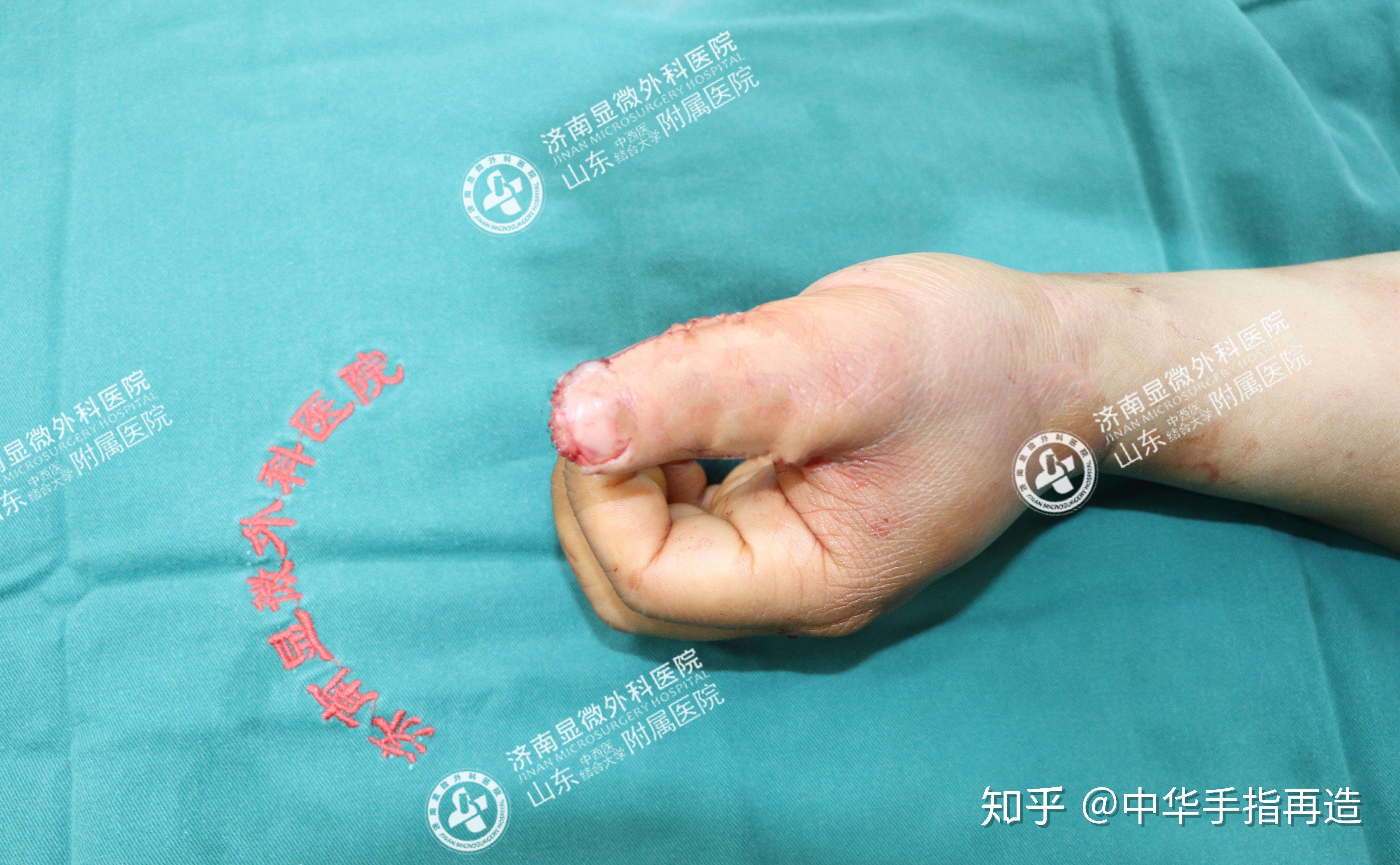 机器无情轧伤拇指3d手指再造帮助恢复健全