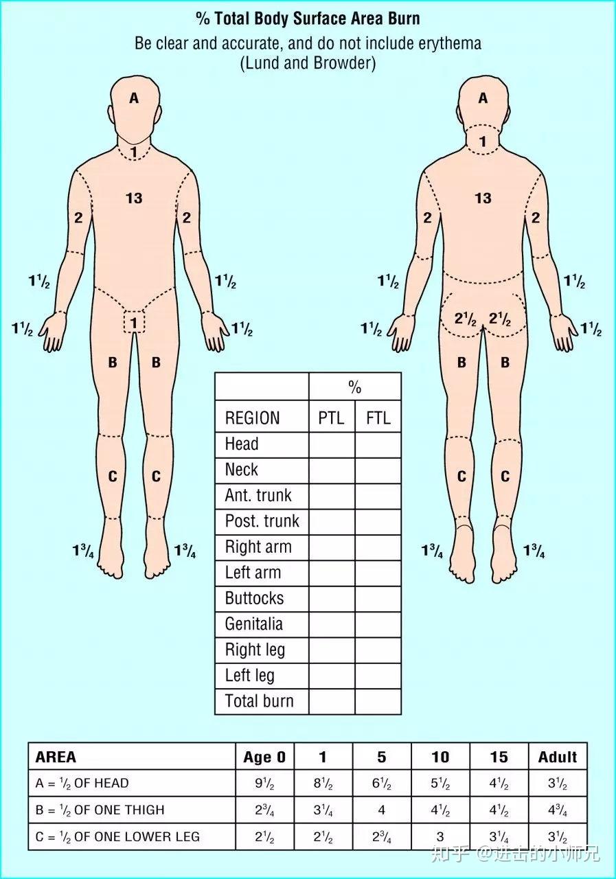护士必会小技巧之烧伤面积计算