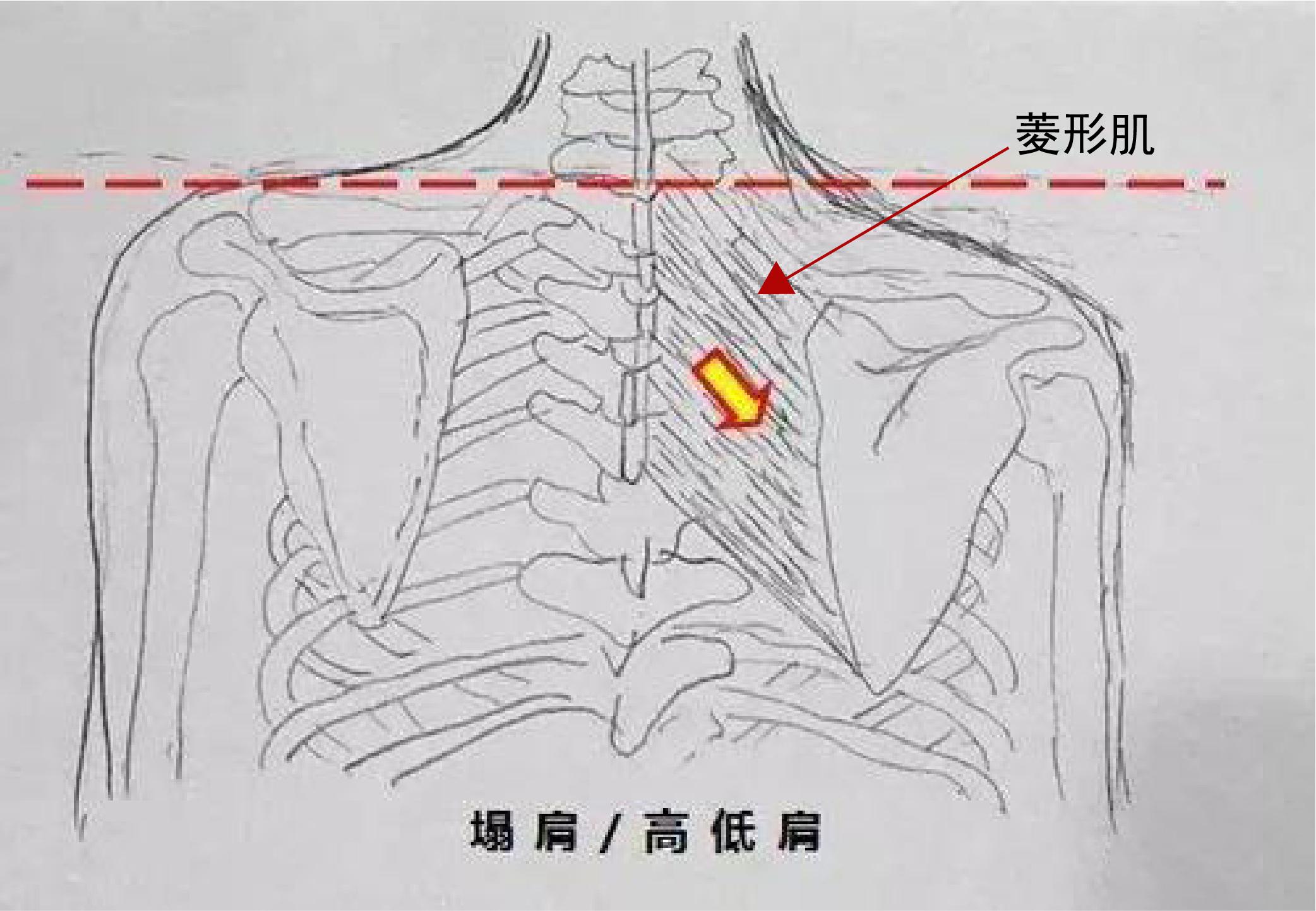 肩膀上提,儘可能的拉伸上背部和中背部,2,菱形肌筋膜(改善聳肩,高低肩