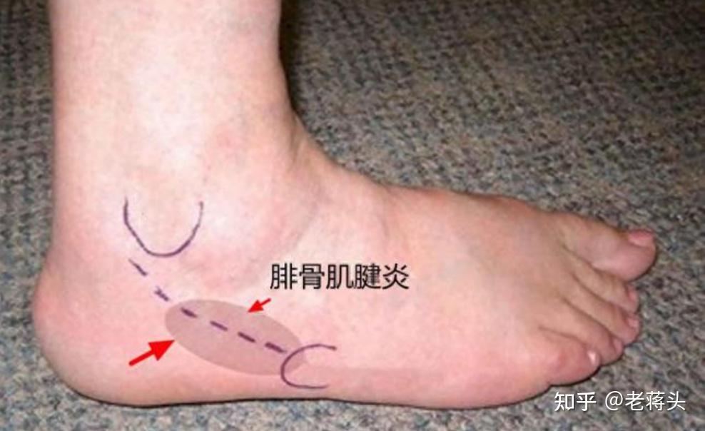 走路脚后跟疼、肌腱弹响肿胀→腓骨肌腱炎 - 知乎