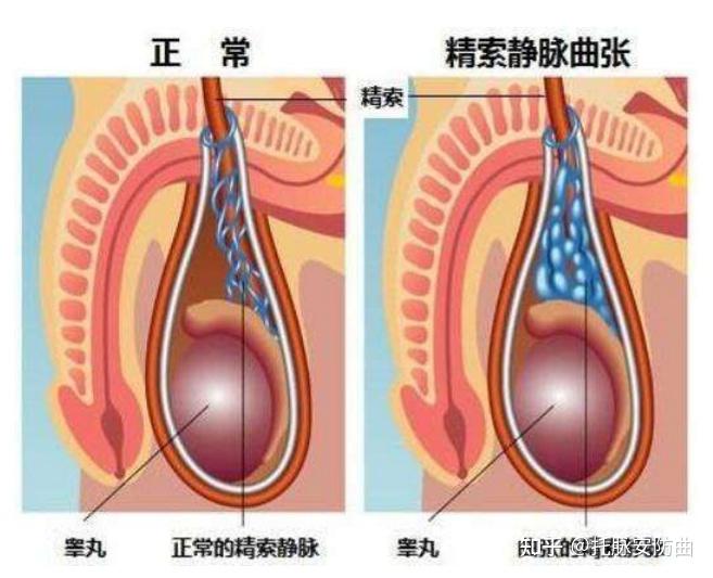 正常精索与曲张精索对比图精索是睾丸上方一个组织,里面包含了静脉