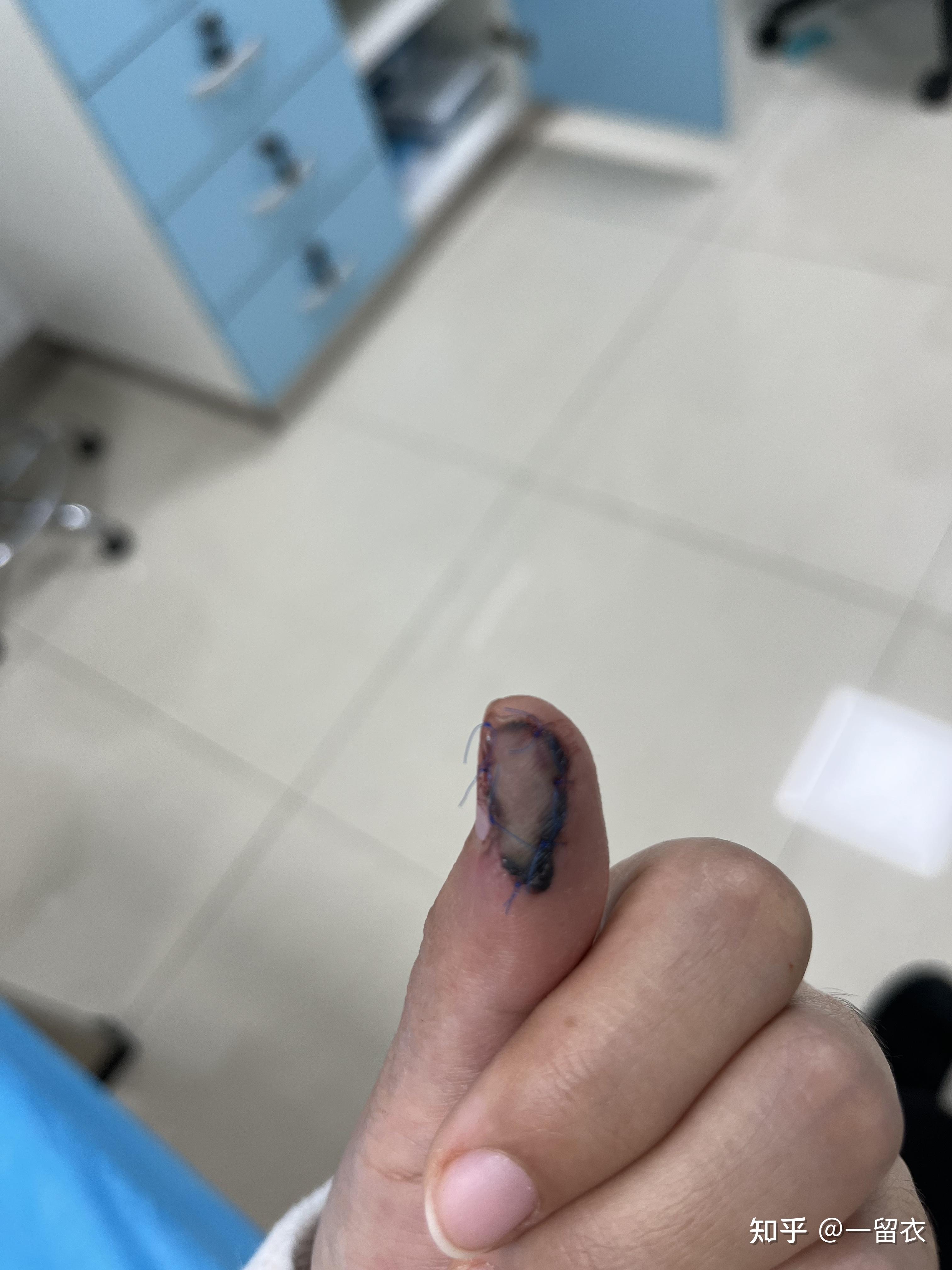 手指切掉一块肉