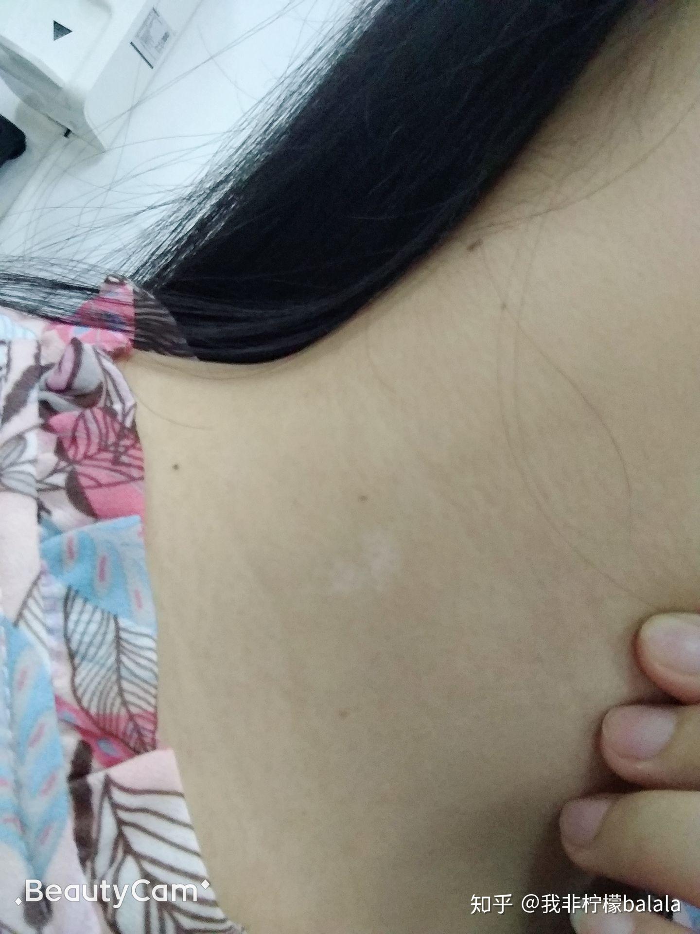 真的没有人拥有白色胎记吗