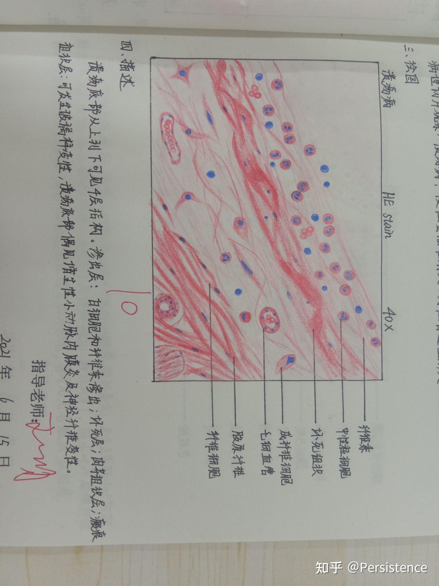 炎性肉芽组织红蓝铅笔图片