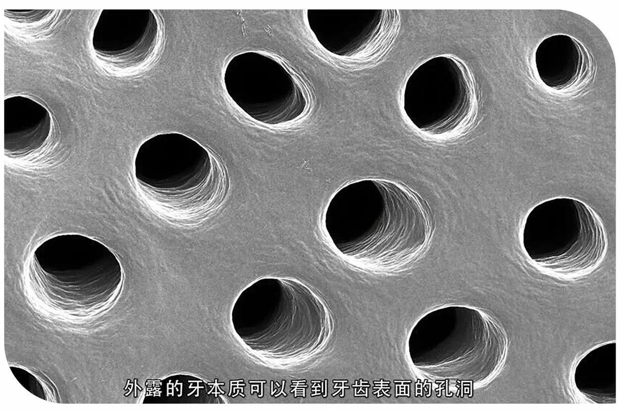 罩牙本质图片