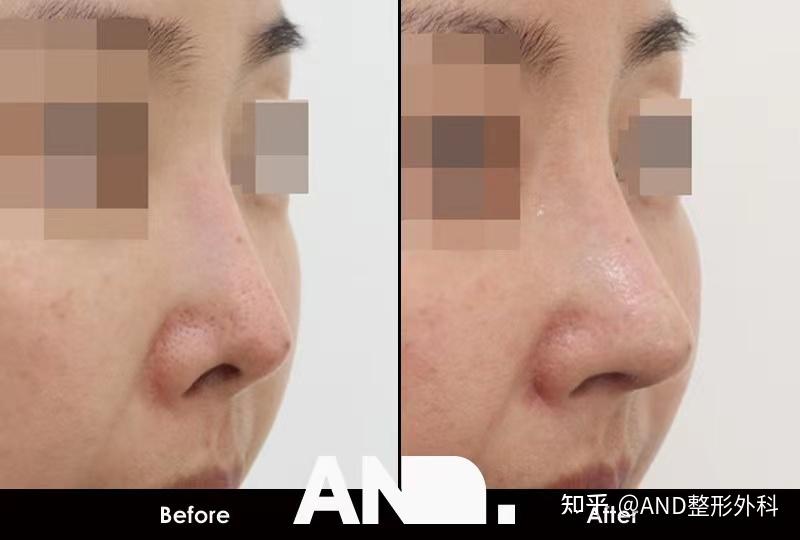 鼻部修复手术打造童颜脸部:鼻部修复手术(鼻梁整形+鼻尖整形+夹鼻+挛缩鼻)前后事例 - 知乎