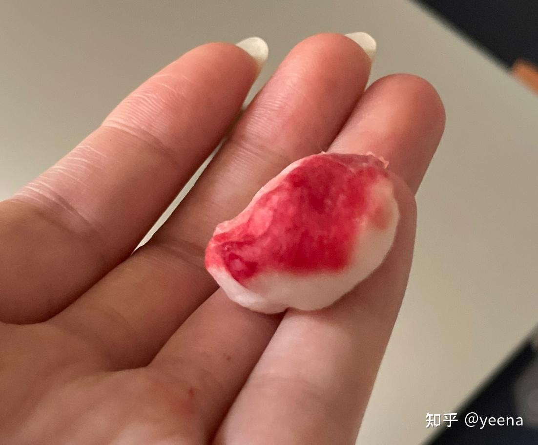 牙龈出血(牙周炎)-洗牙-刮治-拔智齿-拆线的整个经历98