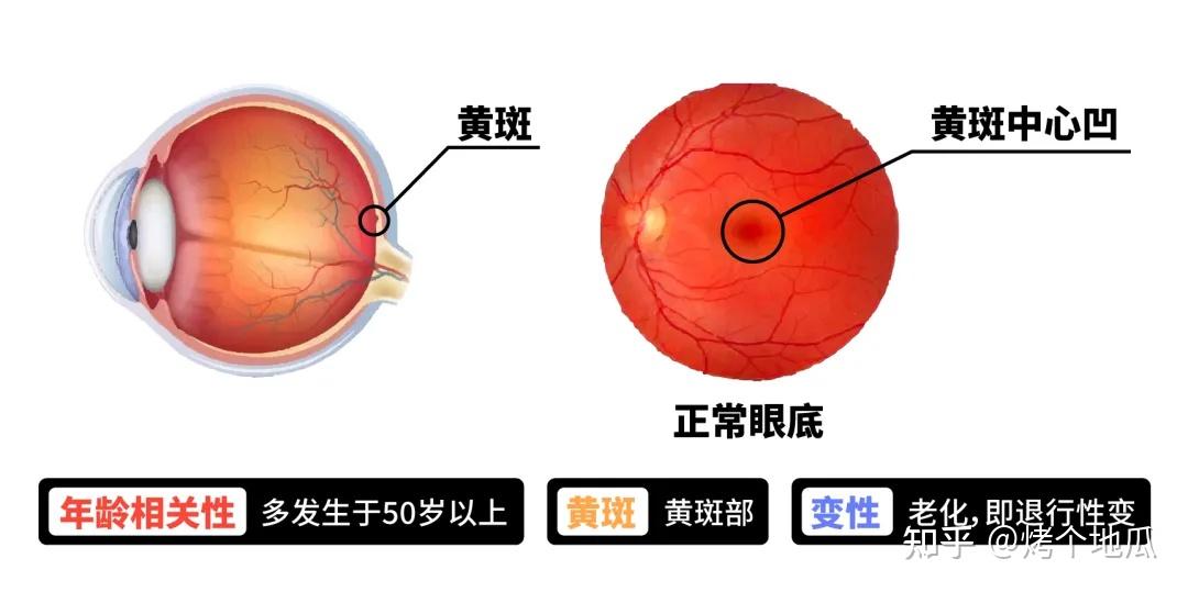 只有老年人才會得黃斑變性嗎