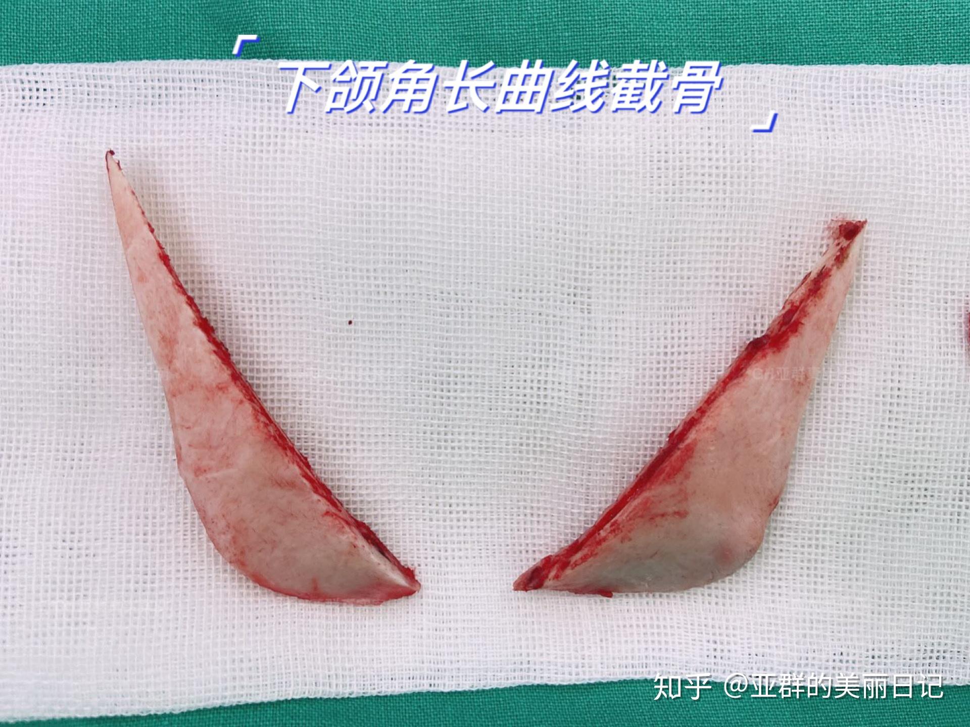 下颌角长曲线截骨术后即刻