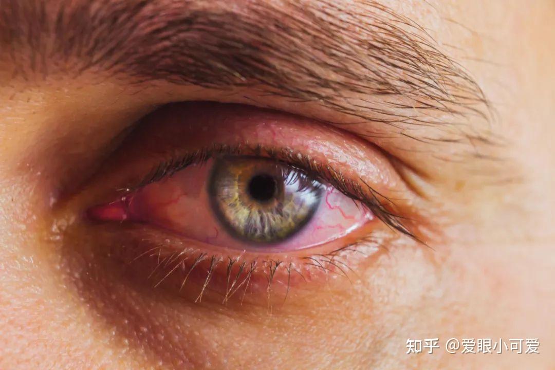什么是红眼病 zhuanlan.zhihu.com