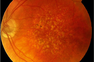 眼底黄斑变性易导致失明,有以下症状及时就医,老年人更应注意
