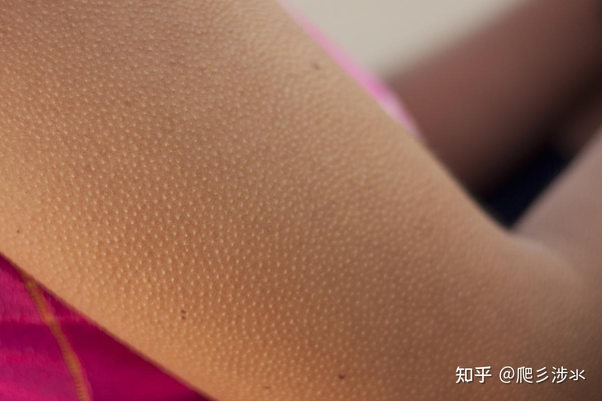 脖颈处皮肤鸡皮疙瘩多知乎(脖子上有类似于鸡皮的皮肤要怎么办)