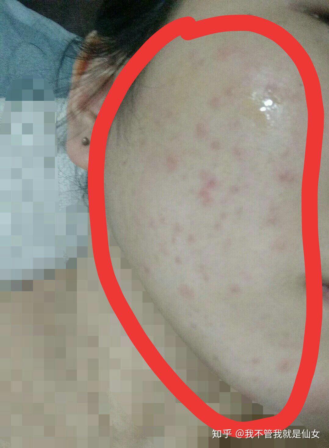 真菌感染,面部体癣,猫咪