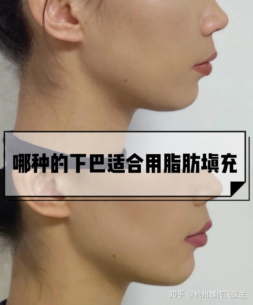 什么样的下巴适合自体脂肪填充 - 知乎