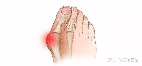 脚疼是怎么回事 不同位置疼痛的原因不同 这篇文章都说全了 知乎
