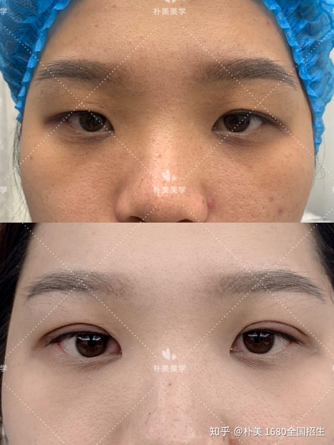 不开刀不手术免麻无痕迹双眼皮