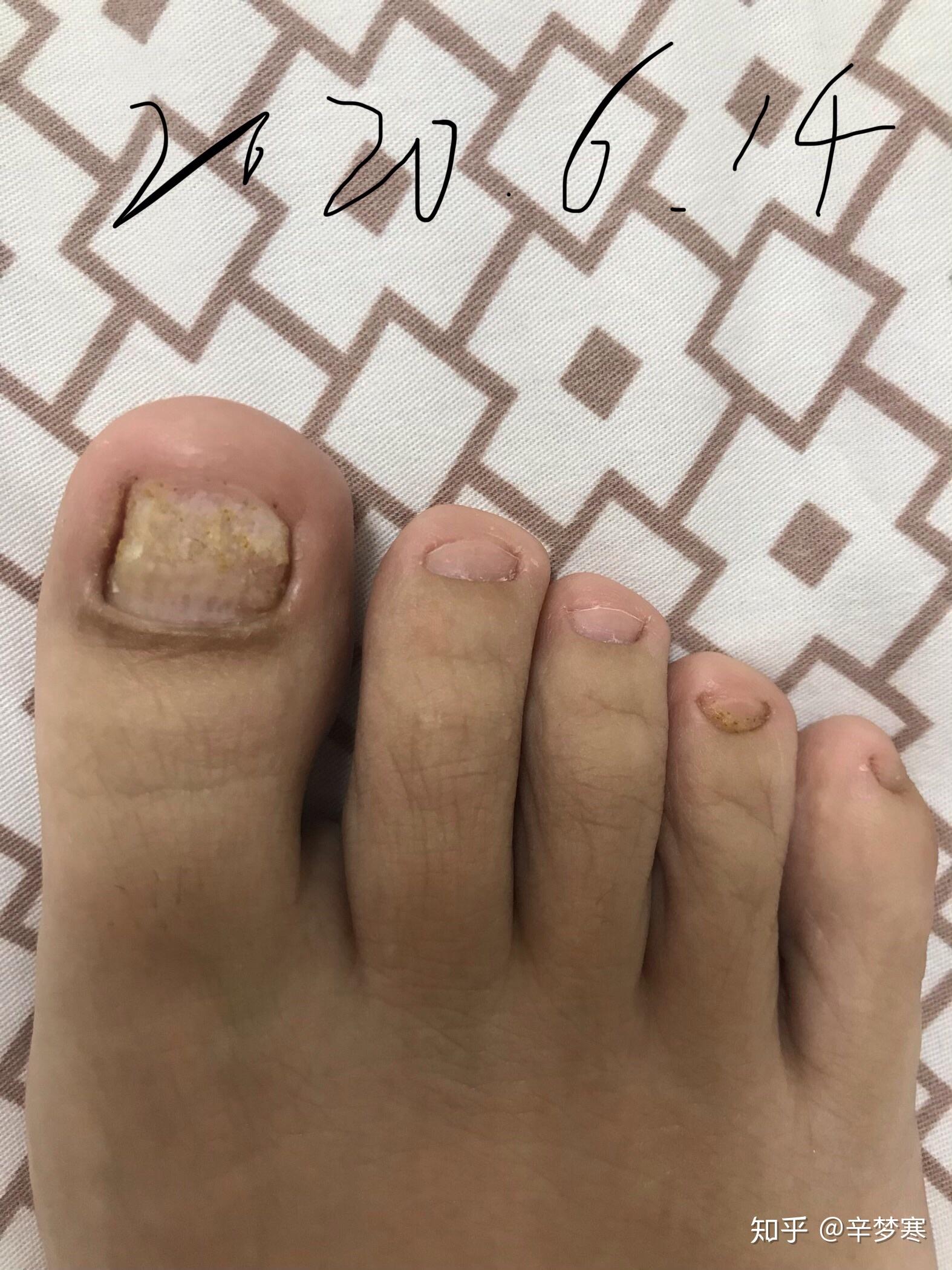 治疗灰指甲qqqqq
