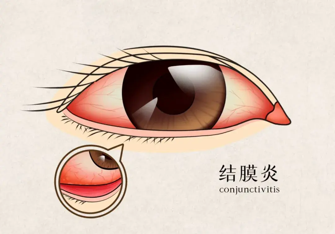 红眼病≠结膜炎,引起结膜炎的原因复杂,日常防范很关键。 - 知乎