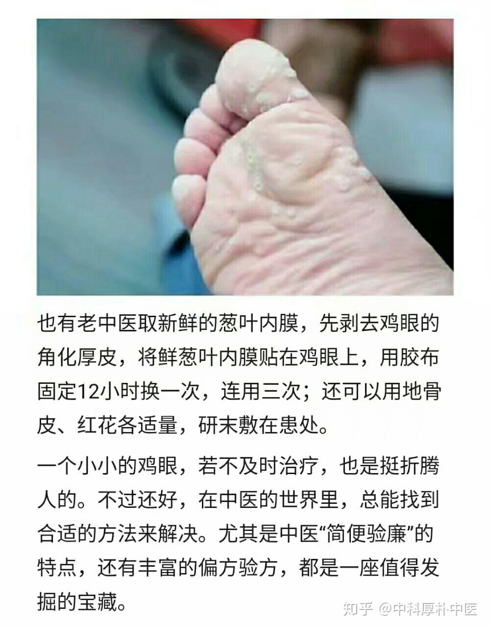 長雞眼是一種怎樣的體驗老中醫竟有這些管用的秘方