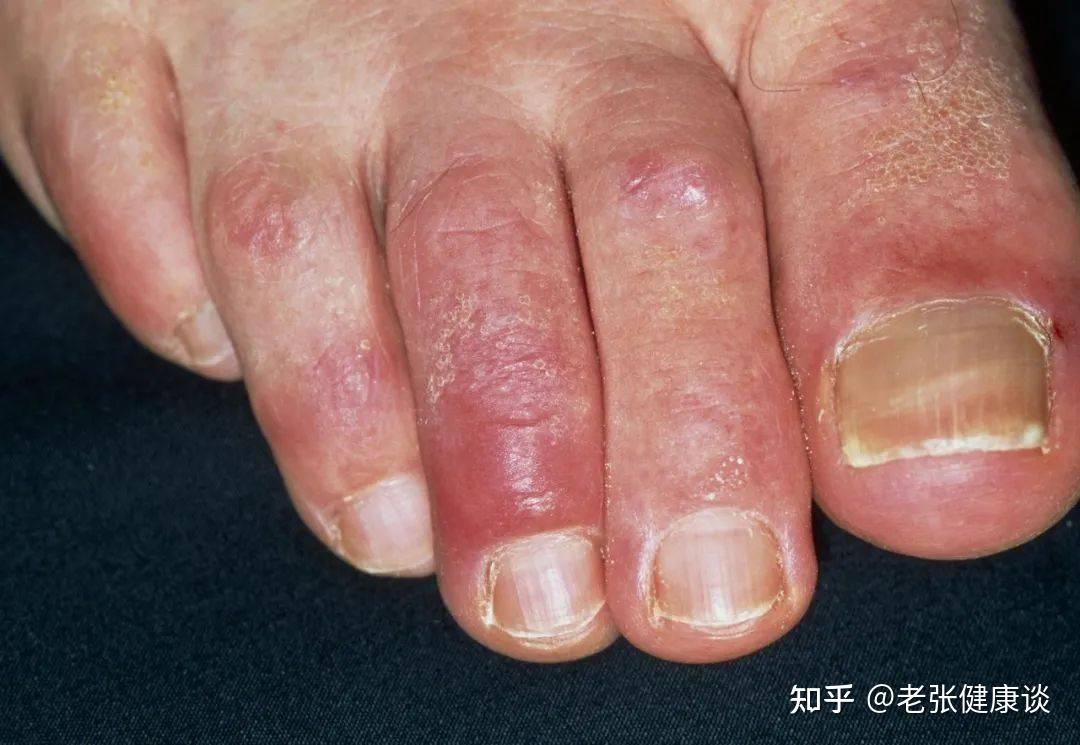 寒冬不想生冻疮,不妨试试这几个妙招,或能助你远离冻疮折磨 - 知乎