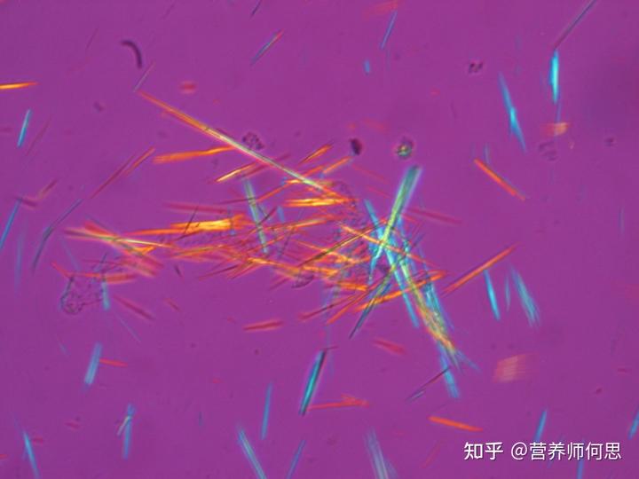 当代年轻人为什么会出现尿酸高? 5 v2 f59a6ab3b3e791c4593b5bc234217b54 720w